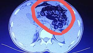 Midelerinden 920 gram uyuşturucu madde çıktı