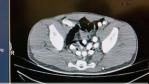 Ağrı'da Midesinde bir kilo uyuşturucu taşıyan kişi yakalandı