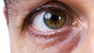 Göz çevresi sorunlarına dikkat! 