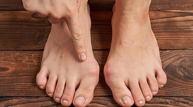 Ayaktaki ağrıların sebebi 'halluks valgus' olabilir!