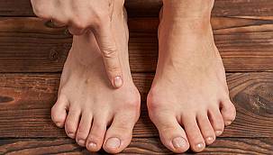 Ayaktaki ağrıların sebebi 'halluks valgus' olabilir!
