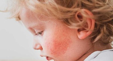 Alerjik reaksiyonların görüldüğü çocuklar için tavsiyeler