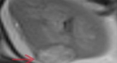 Ağrı'da sağlık alanında ilk defa bu operasyon yapıldı