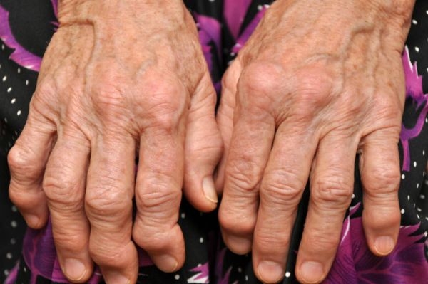 'Tedavinin başarısı için sağlıklı bir hekim-hasta ilişkisi şart'