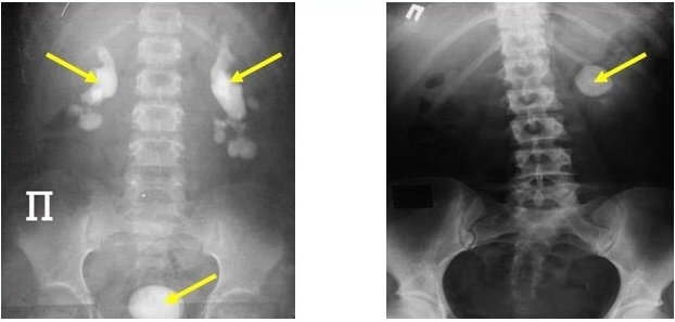 Sessiz böbrek taşlarına dikkat!