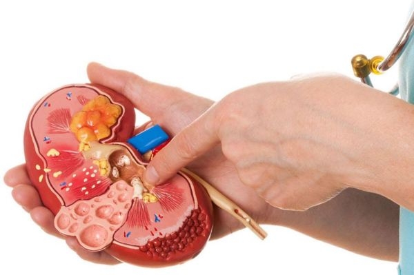 'Böbrek taşları hiçbir belirti vermeden oluşabiliyor'