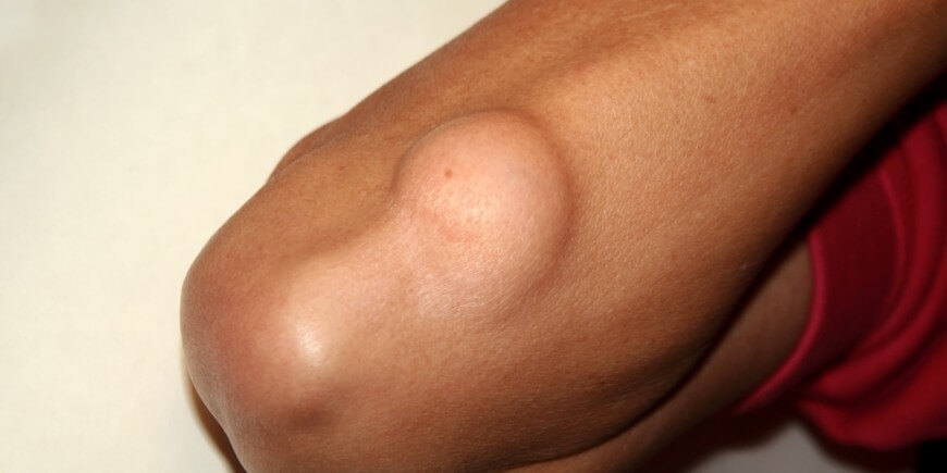 'Yağ bezesinden 5 dakikada kurtulun'